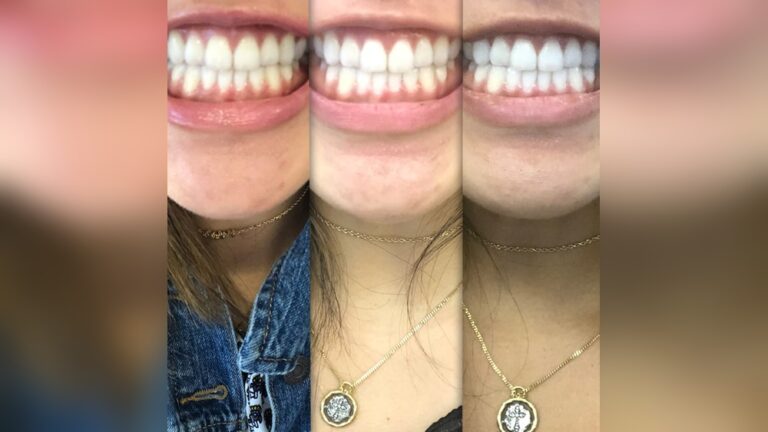 Do Led Lights Help Whiten Teeth